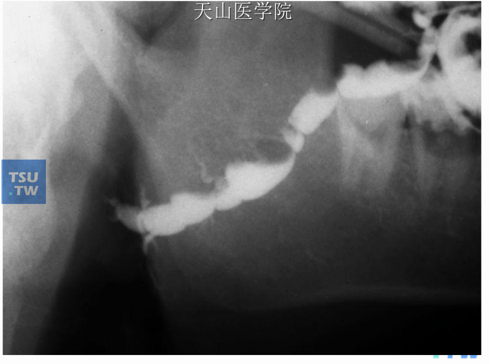 左腮腺导管阴性结石，腮腺造影可见主导管内造影剂充盈缺损，主导管明显扩张