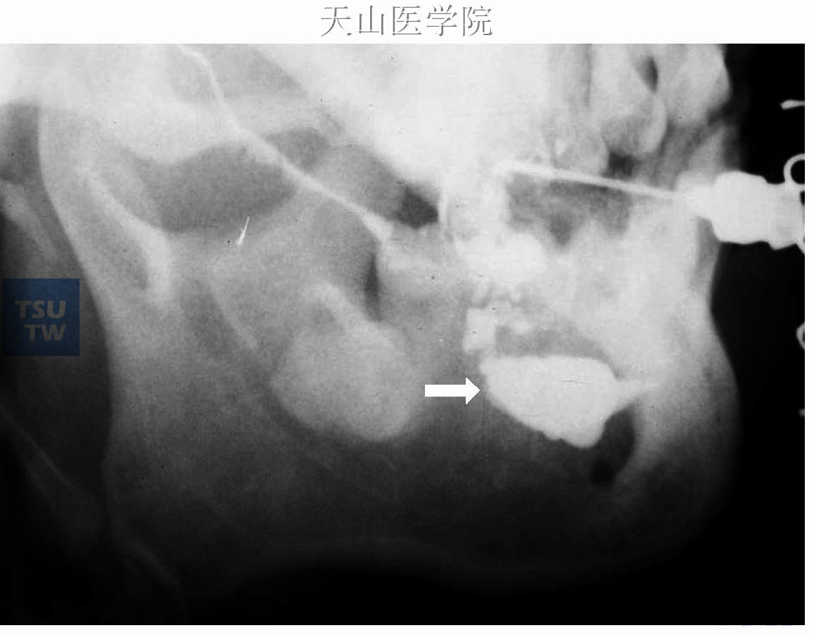 左腮腺导管瘘，患者2周前左面部刀刺伤，腮腺造影时自左腮腺自然导管口注入造影剂，可见造影剂在导管瘘处漏出（↑）