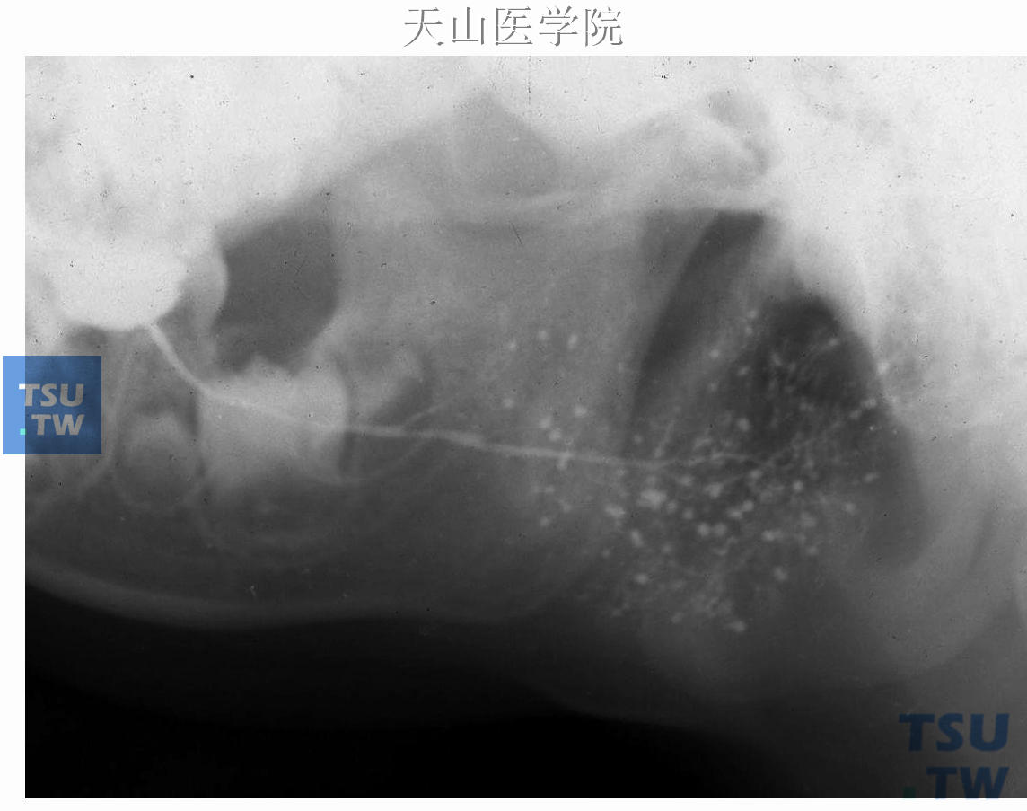 右腮腺儿童复发性腮腺炎，腮腺造影显示多数末梢导管点状扩张，并累及副腺体