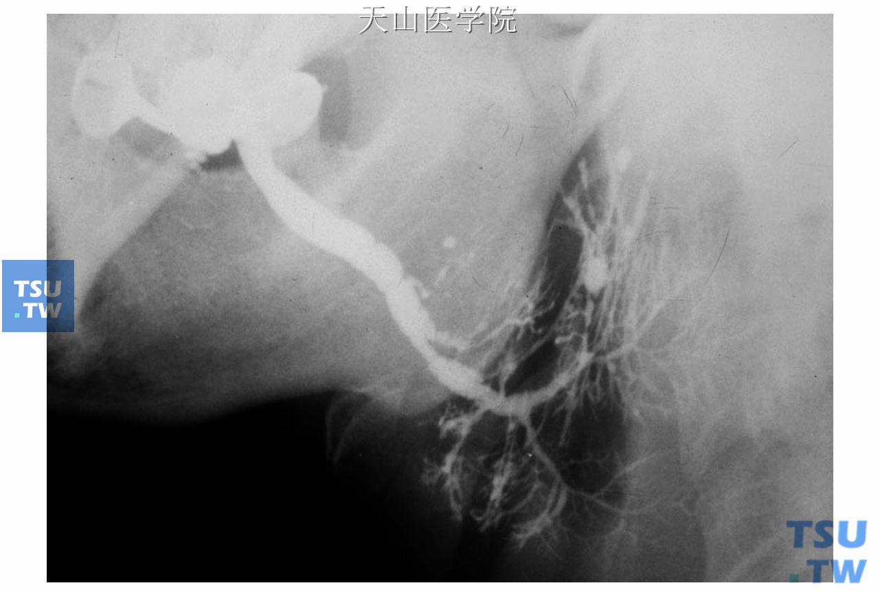 右侧阻塞性腮腺炎，腮腺造影显示主导管明显扩张，分支导管扩张