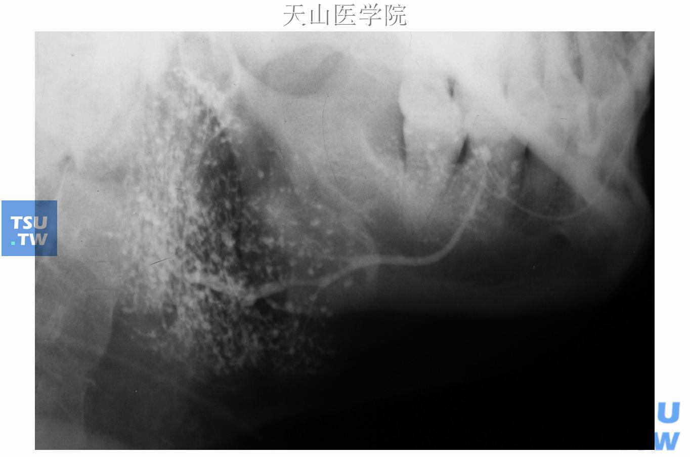 干燥综合征，左腮腺造影显示大量末梢导管扩张呈点状、球状，腺内段主导管稍扩张