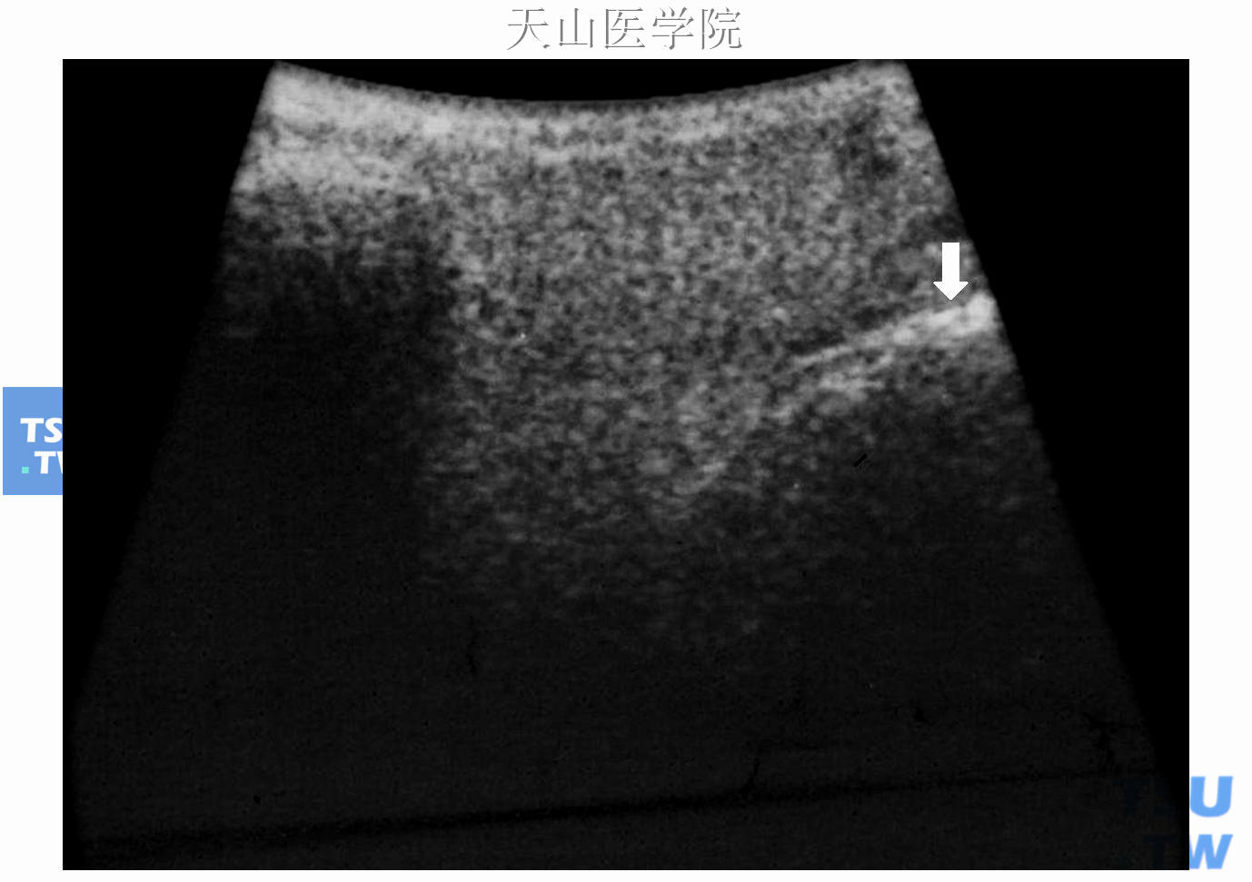 腮腺横切面超声声像图，腮腺呈均匀细腻的点状回声，图像右侧的强回声为下颌骨升支的影像（↑）