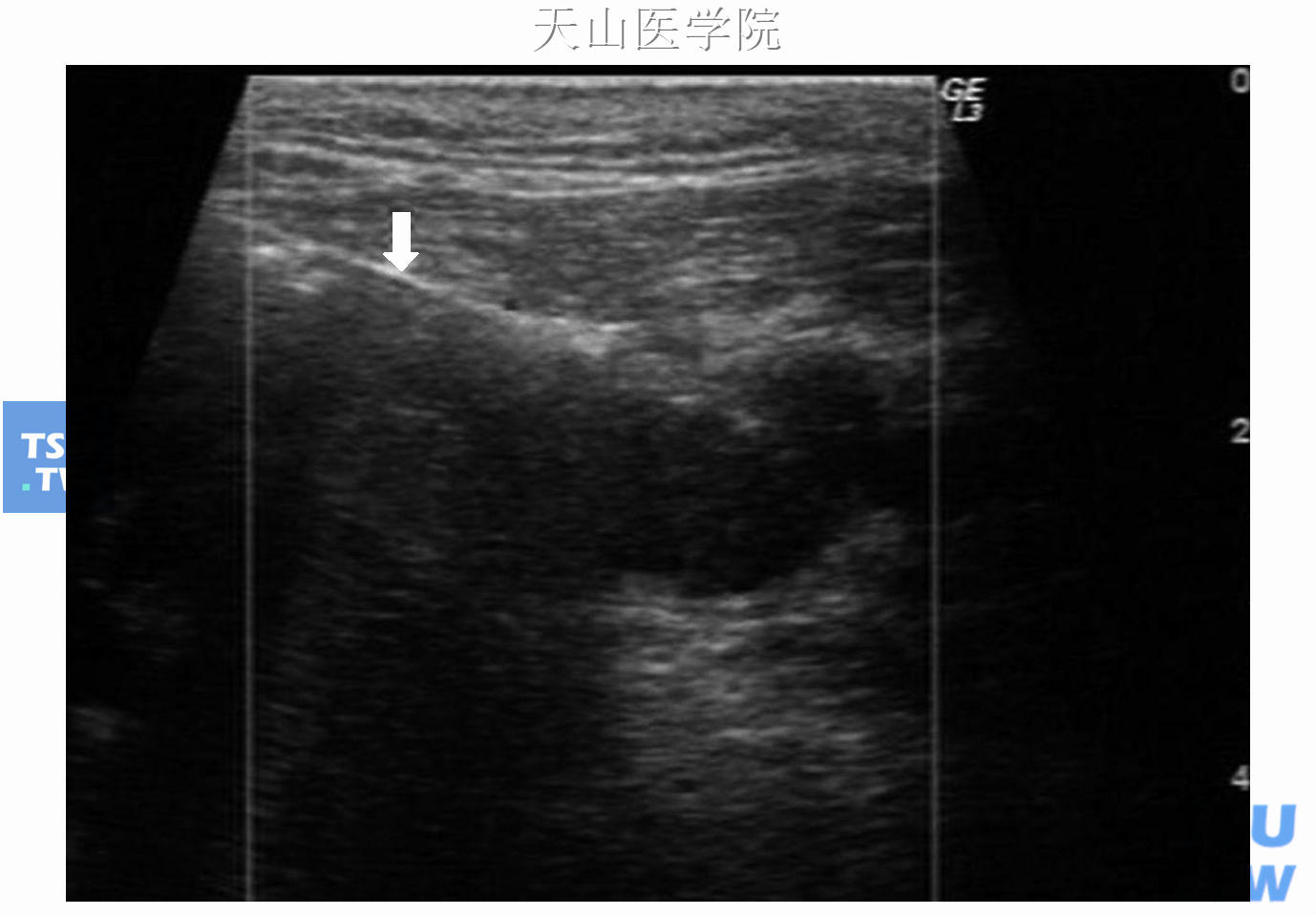 左腮腺肿物，超声引导下穿刺活检，可见穿刺针进入肿瘤（↑）