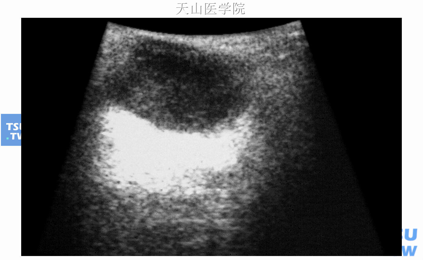 腮腺多形性腺瘤，超声声像图显示肿瘤形态规则，边界清楚，内部回声均匀，后方回声增强