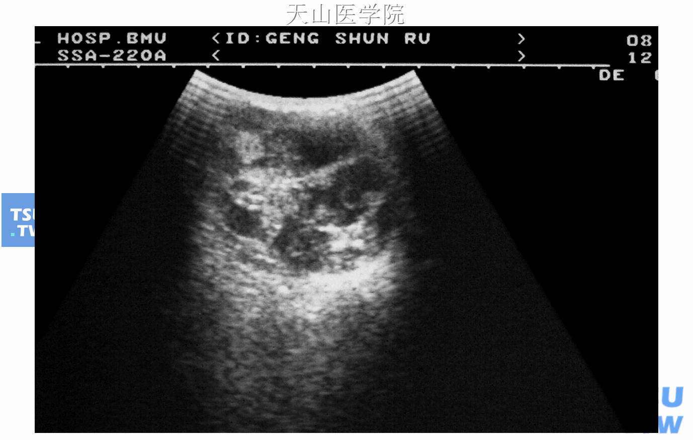 腮腺混合瘤超声表现图片