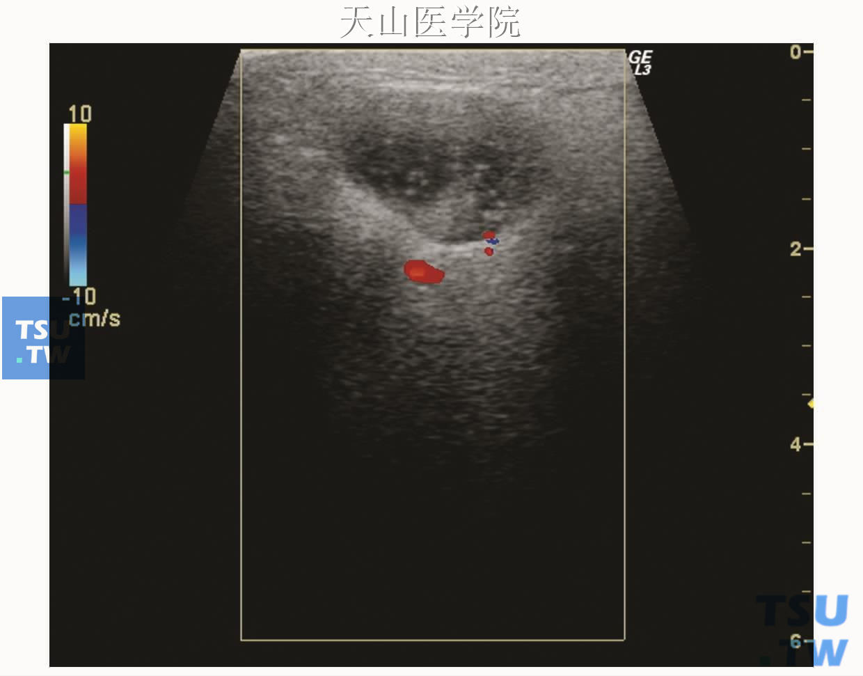 腮腺淋巴上皮囊肿，声像图显示病变边界清楚，内部呈无回声，其中可见点状中等回声，后方回声增强