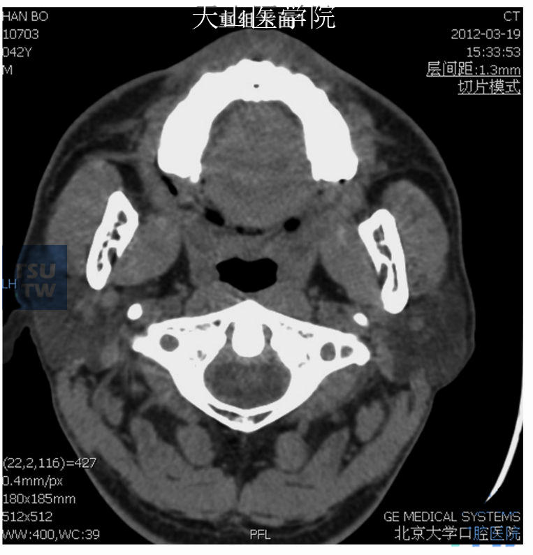 腮腺ct断层解剖图图片