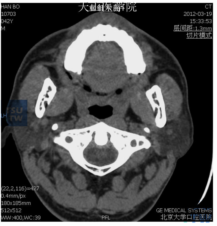 正常腮腺CT轴状位