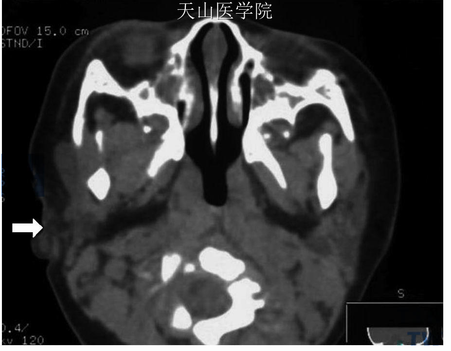 右腮腺先天缺失，轴位CT见右腮腺缺如（↑）