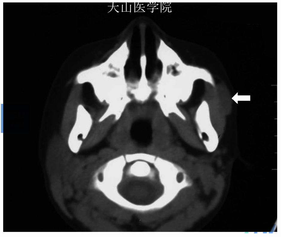 左腮腺异位，CT轴位可见左腮腺缺失，左侧咬肌外软组织影（↑）