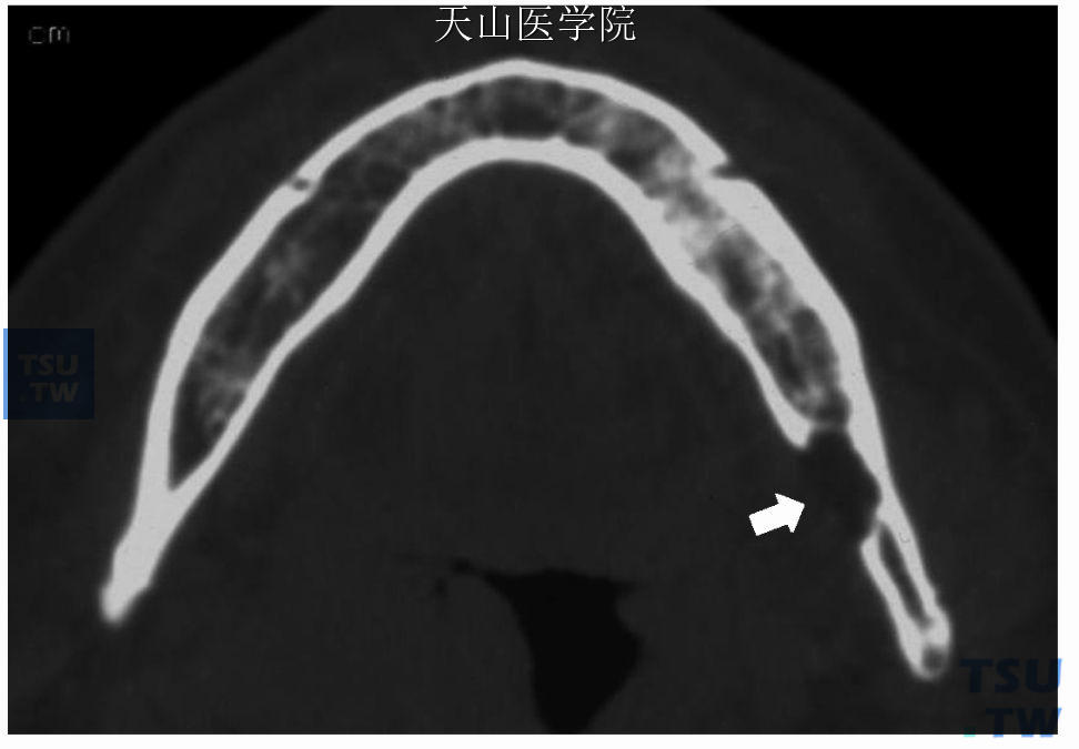 左下颌骨静止性骨腔，轴位CT可见病变的舌侧骨板缺失（↑）