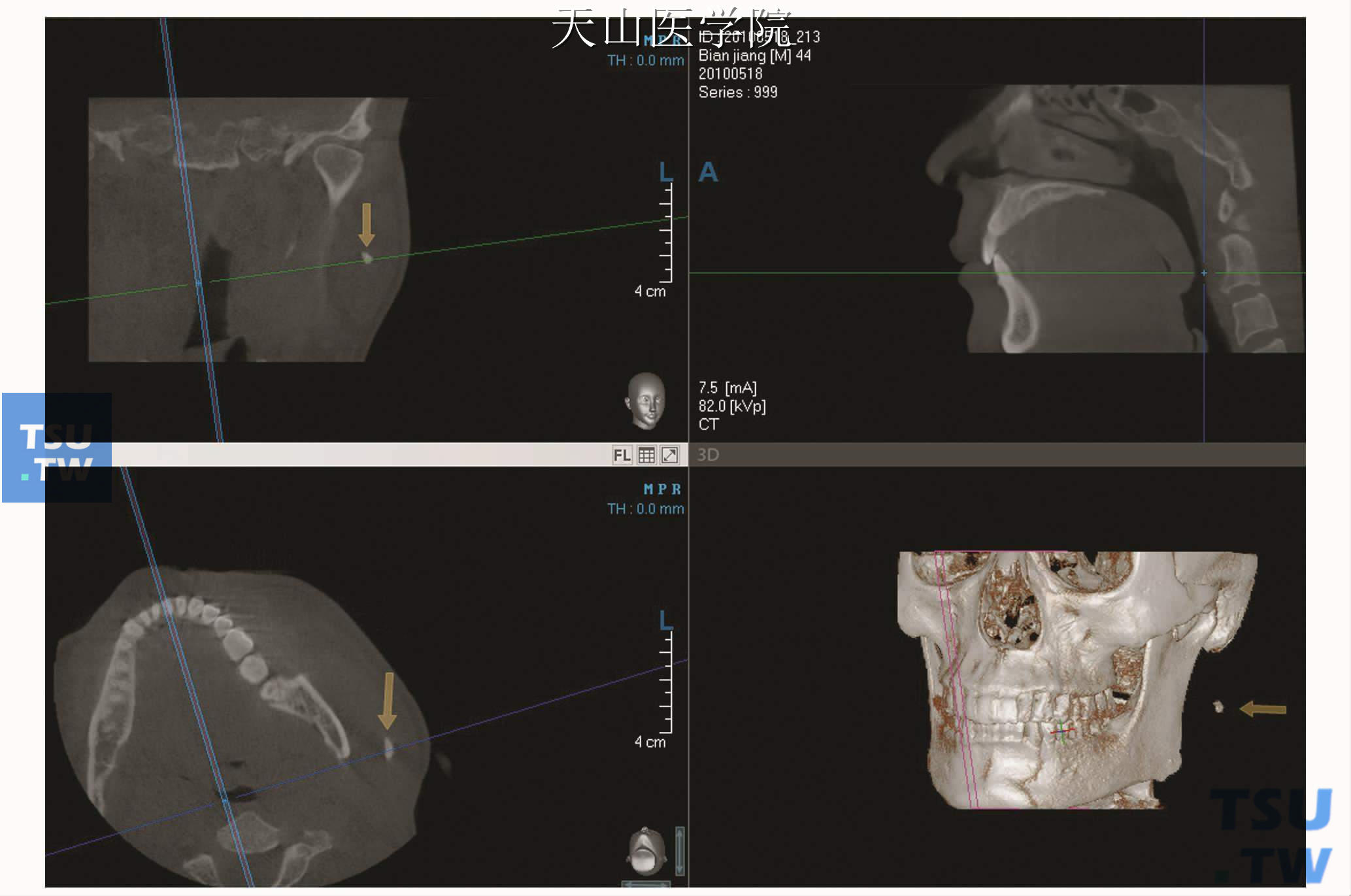 左腮腺导管结石，锥形束CT可见左侧腮腺导管走行区约升支后缘处高密度影像（↑）