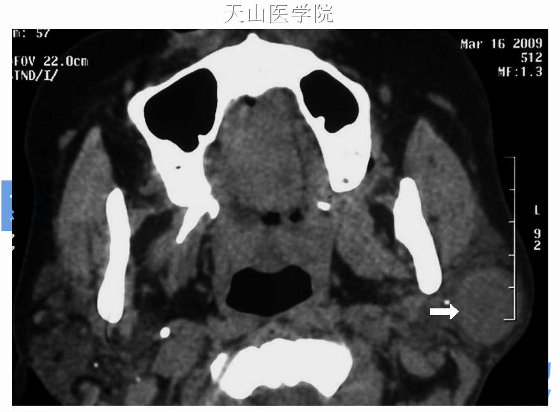 左腮腺多形性腺瘤，CT轴位可见左腮腺软组织肿物影，圆形，边界光滑，内部X线密度均匀（↑）