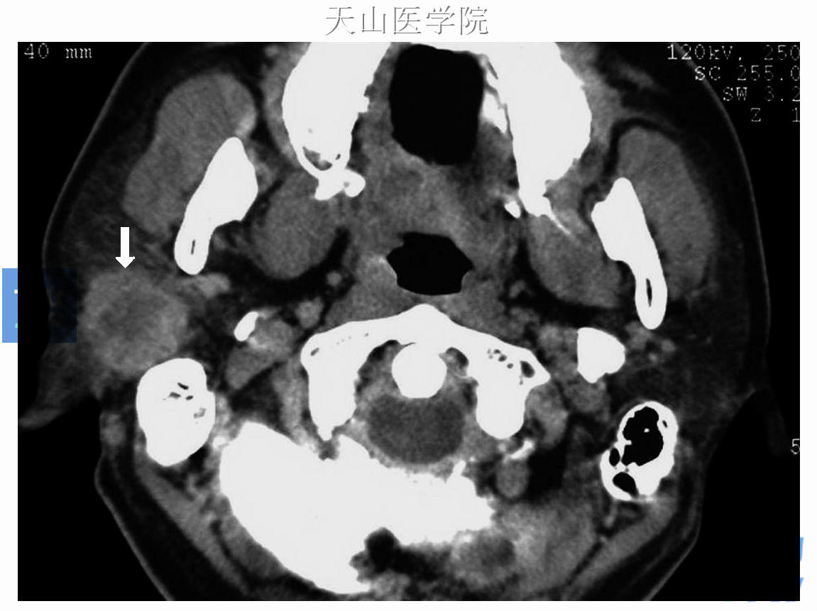 右腮腺恶性多形性腺瘤，轴位CT可见有腮腺软组织肿物，形态不规则，部分边界不清楚，内部X线密度不均匀（↑）