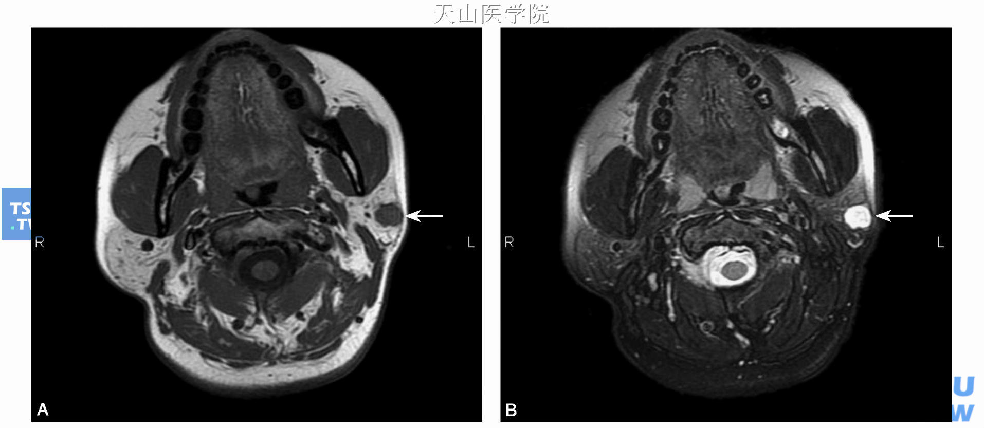 左腮腺多形性腺瘤磁共振图像，A为T1加权像，肿瘤呈等信号，边界清楚（↑），B为T2加权像，肿瘤呈不均匀高信号（↑）