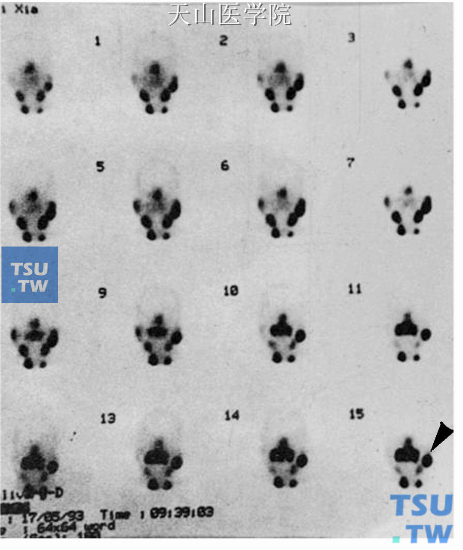 右腮腺Warthin瘤，核素显像显示“热结节”（↑）