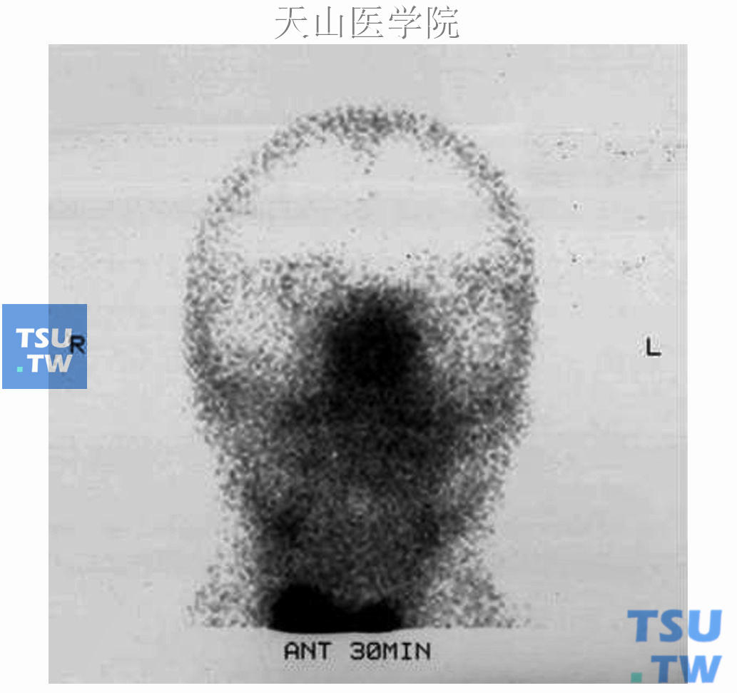 双侧腮腺无明显核素摄取，提示功能严重受损