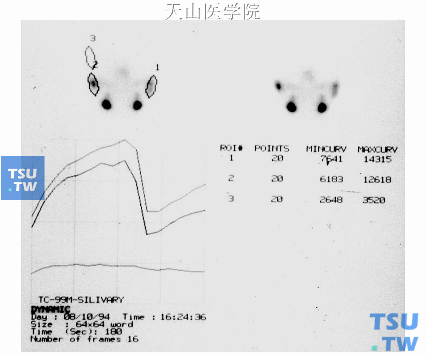 左侧腮腺Warthin瘤部分腮腺切除术后，两侧腮腺功能曲线相似，提示功能接近正常