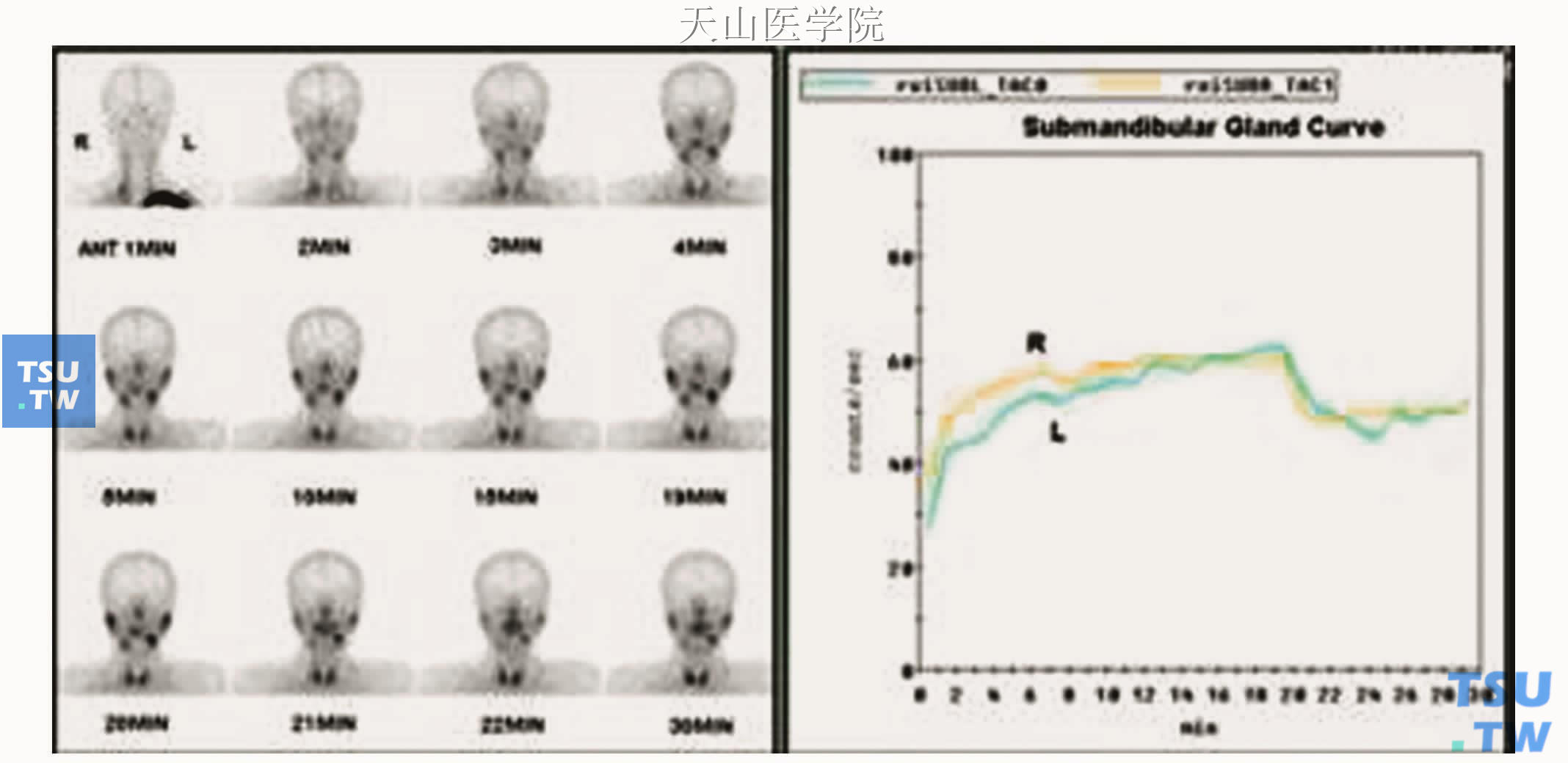 右侧下颌下腺腺门部结石口内切开取石术后，功能曲线（R）与左侧（L）相似，提示功能接近正常