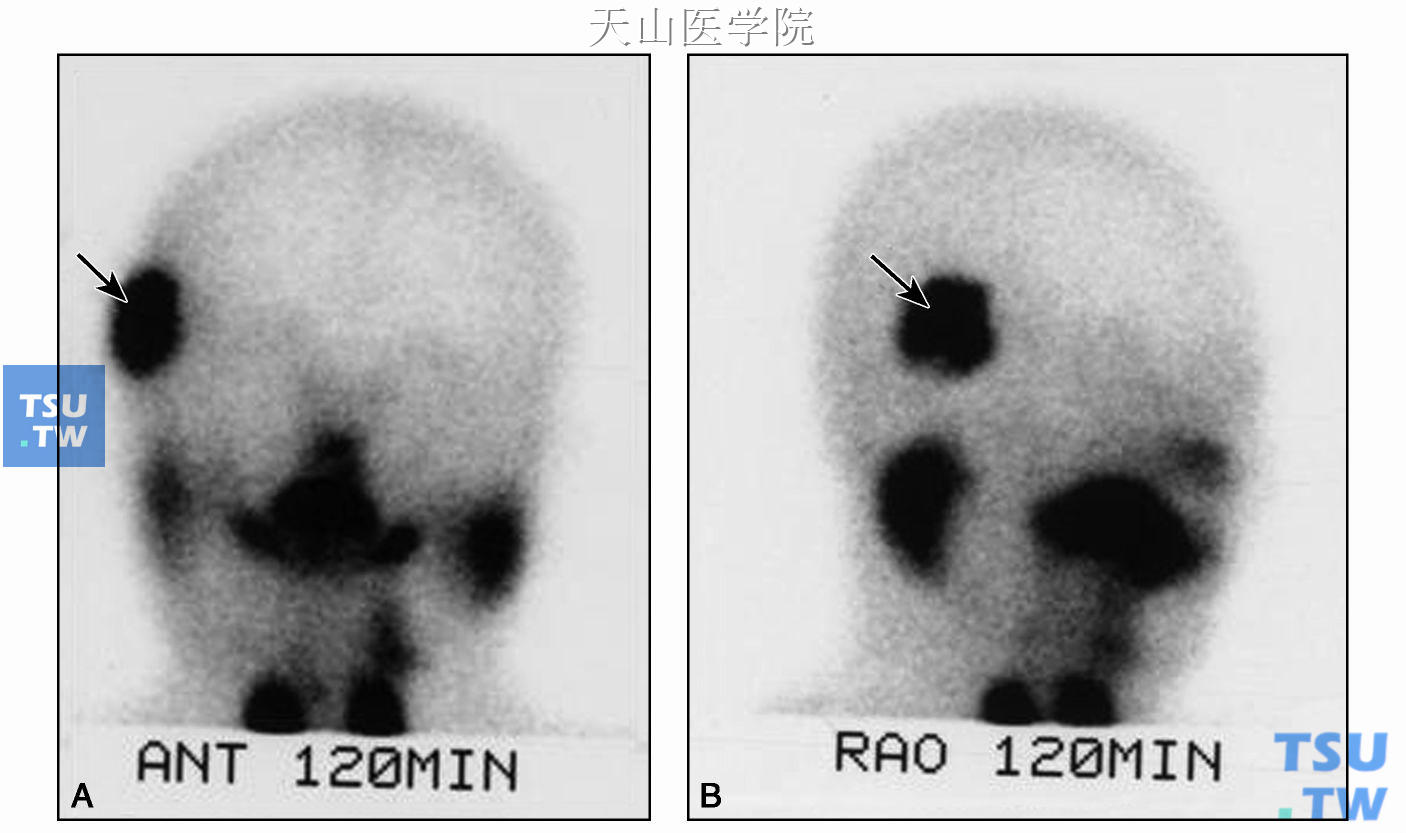 后前位（A）和侧位（B）核素显像，显示颞部有核素摄取（↑） 提示移植腺体成活