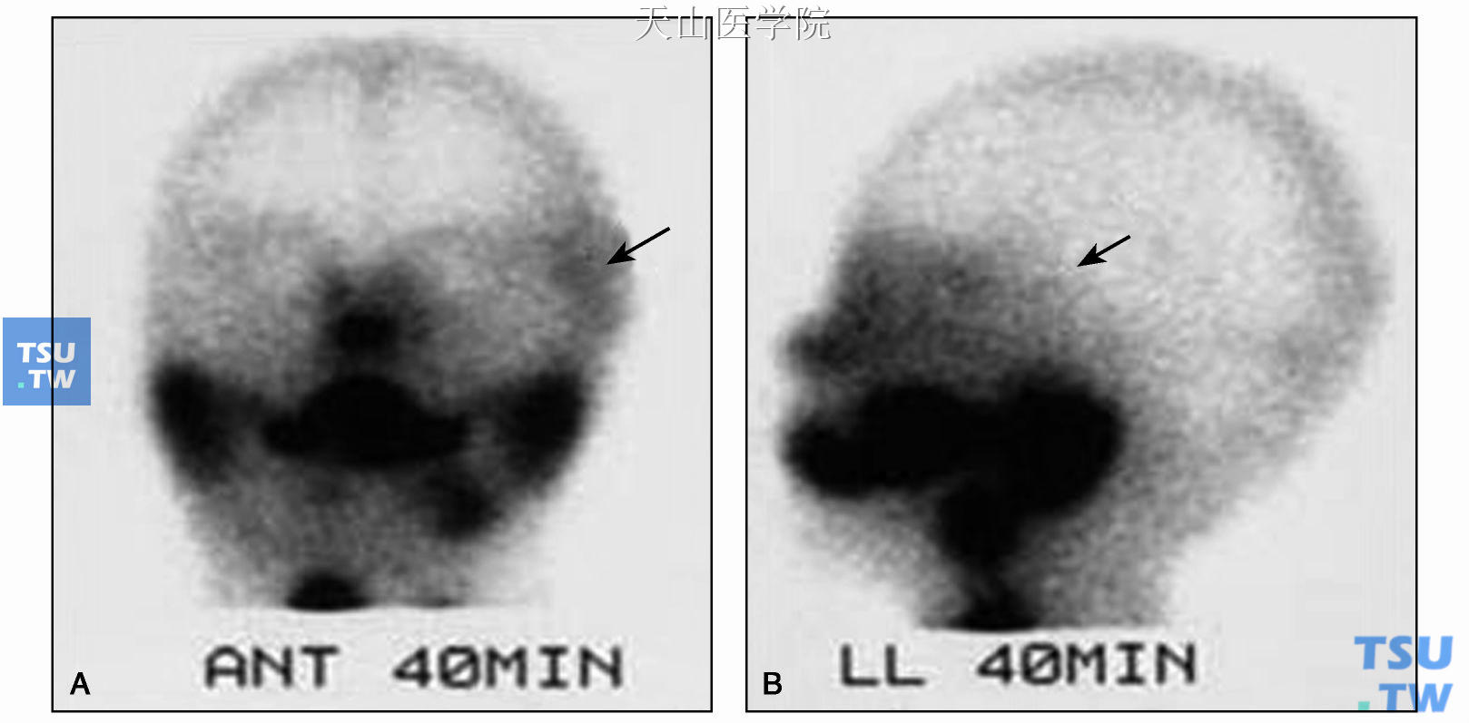 后前位（A）和侧位（B）核素显像，显示颞部无核素摄取（↑），提示移植腺体未能成活