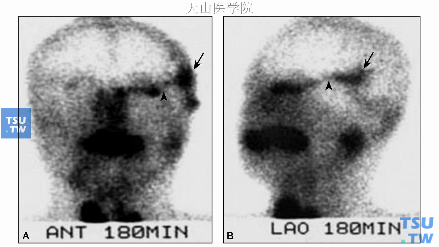 后前位（A）及侧位（B）核素显像，显示核素经移植腺体（↑）的导管（?） 进入眼眶，提示导管通畅
