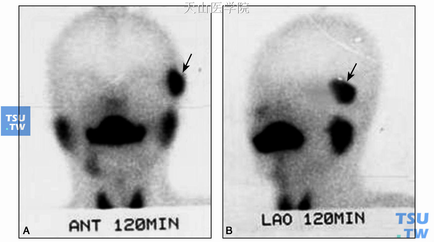 后前位（A）及侧位（B）核素显像，显示眼眶内无核素摄取，提示移植下颌下腺（↑）导管阻塞