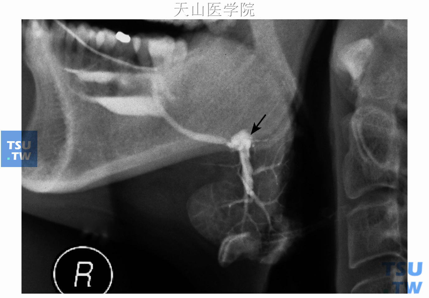 取石术后下颌下腺造影：示导管腺门部膨大（↑）