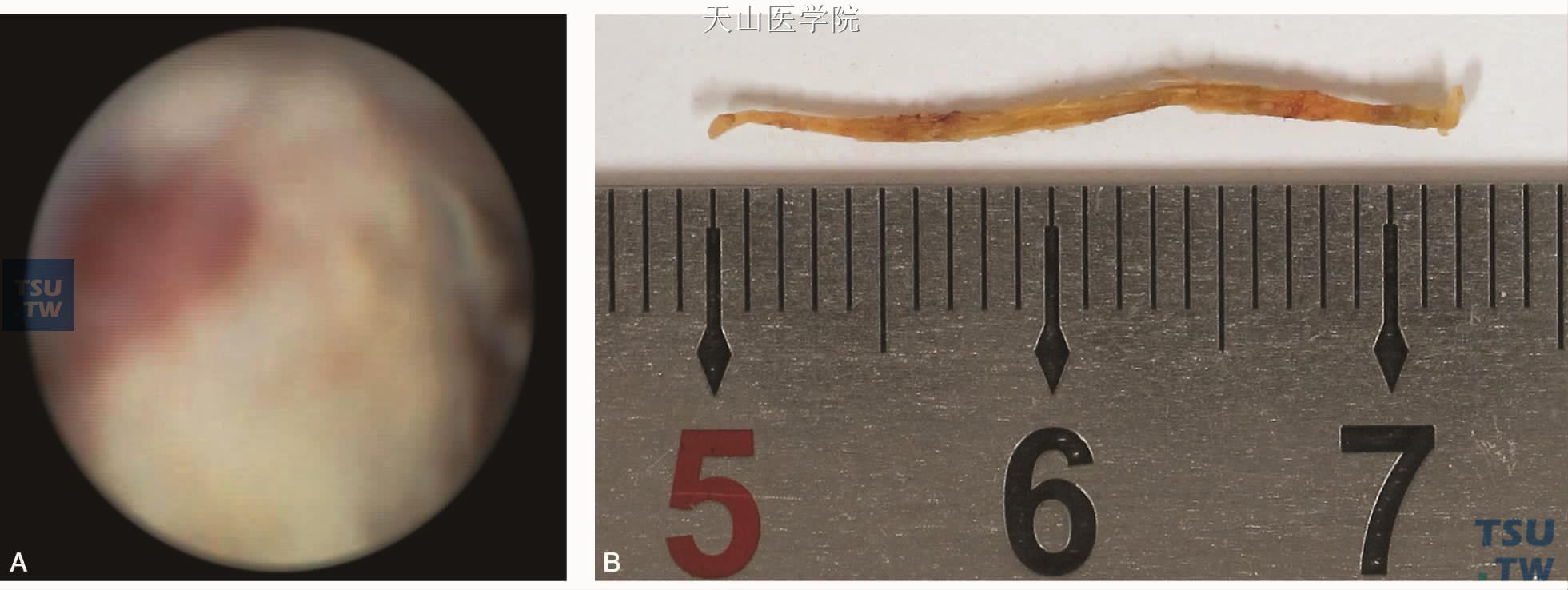 下颌下腺导管异物：A.内镜下见异物；B.内镜直接取出的异物（草杆）