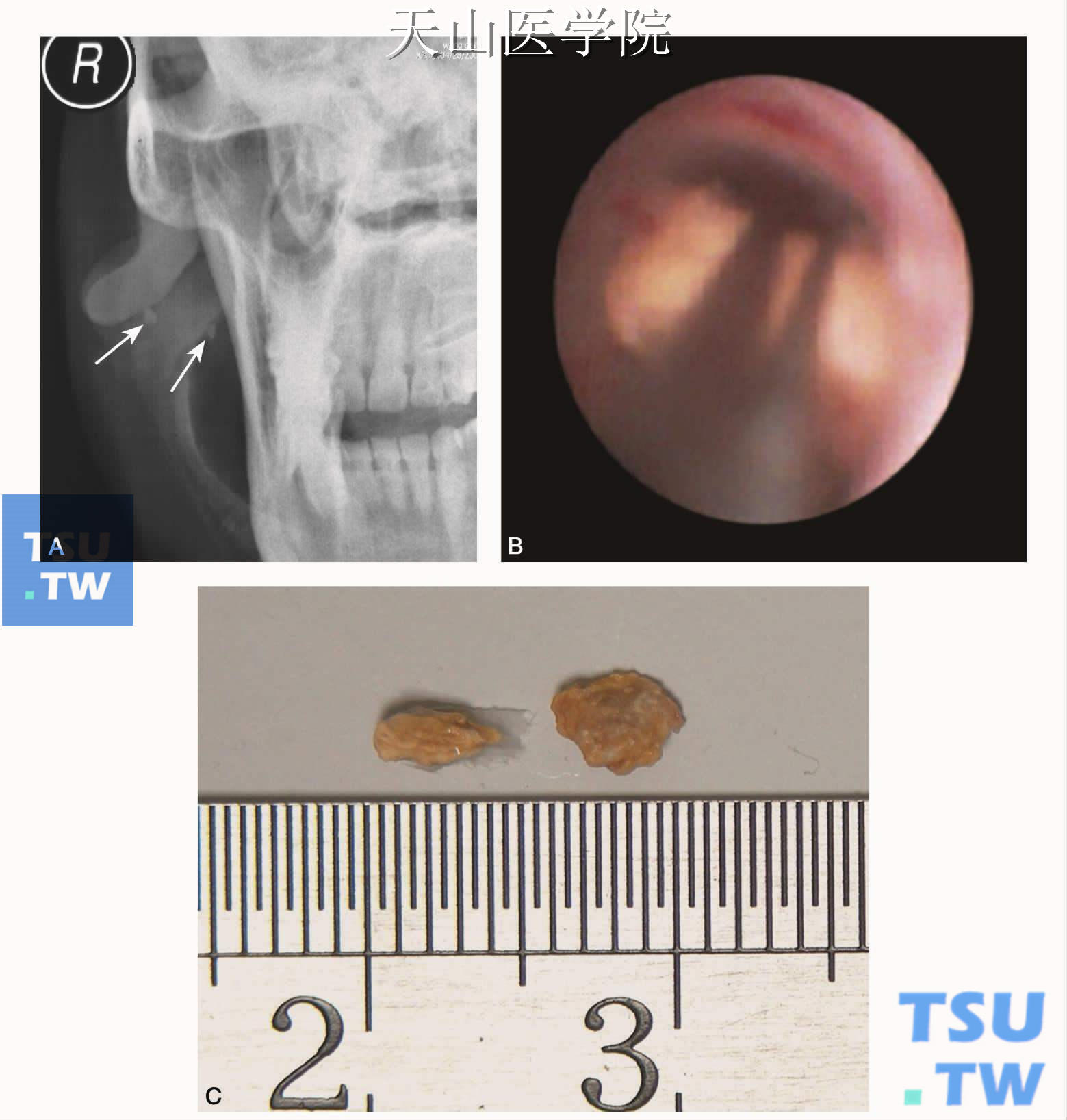 右腮腺导管结石：A.腺鼓颊后前位片显示2枚腮腺导管结石（↑）；B.镜下将结石以网篮套索；C.网篮直接取出的2枚结石