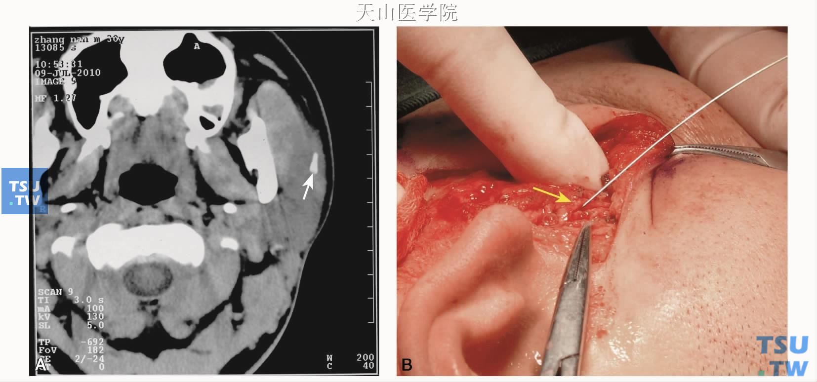 A.轴位CT图像显示左腮腺导管腺门部结石（↑）；B.腮腺翻瓣后解剖主导管取石，并经主导管切口（↑）探查导管腺内段，取出残余结石；