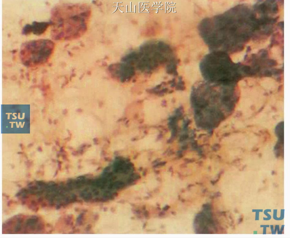 慢性下颌下腺炎：左上方可见腺细胞，左下为增生的导管上皮×200