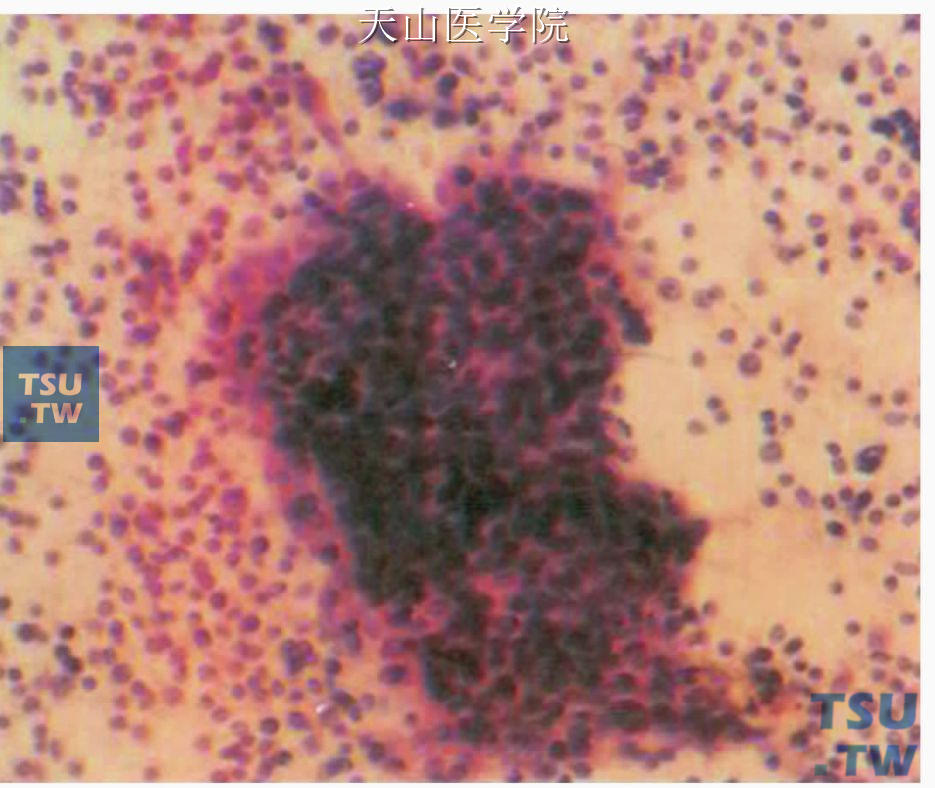 良性淋巴上皮病变：粉染成团增生的导管上皮团位于淋巴细胞中×200