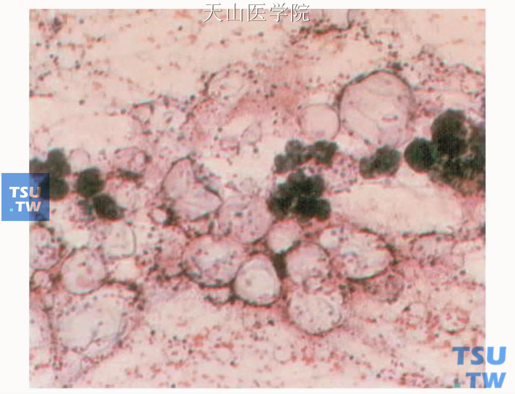 腮腺良性肥大：腺上皮细胞团位于成堆的脂细胞中