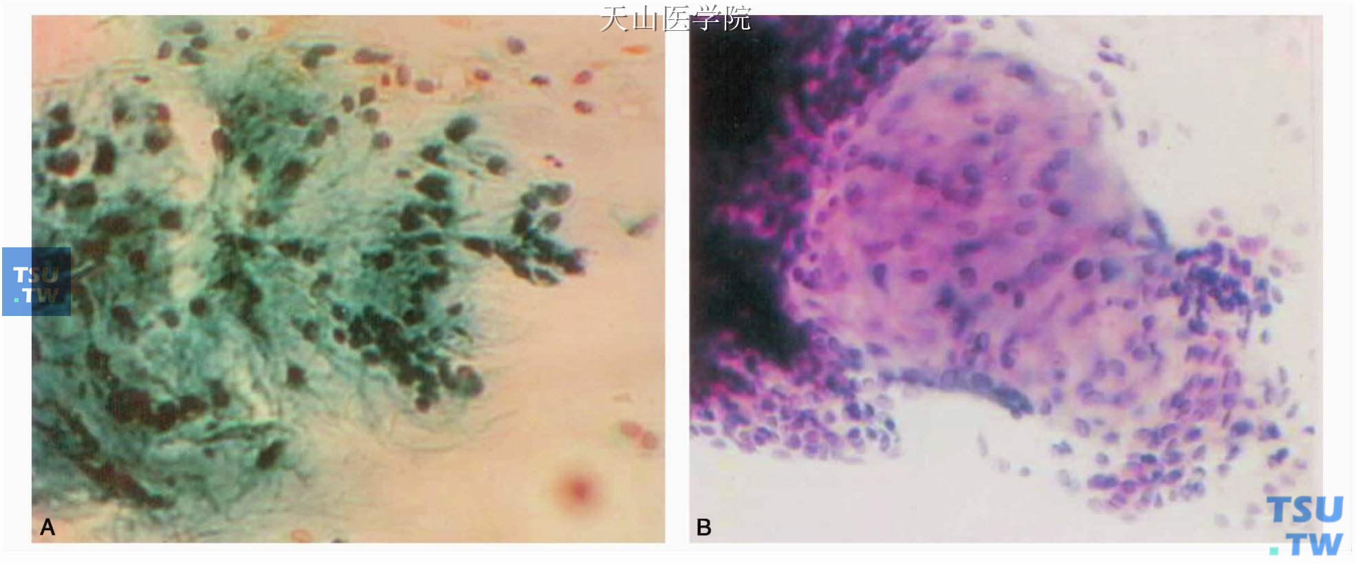 典型的多形性腺瘤的细胞学表现：A.间质呈羽绒丝状；B.间质呈黏液样表现