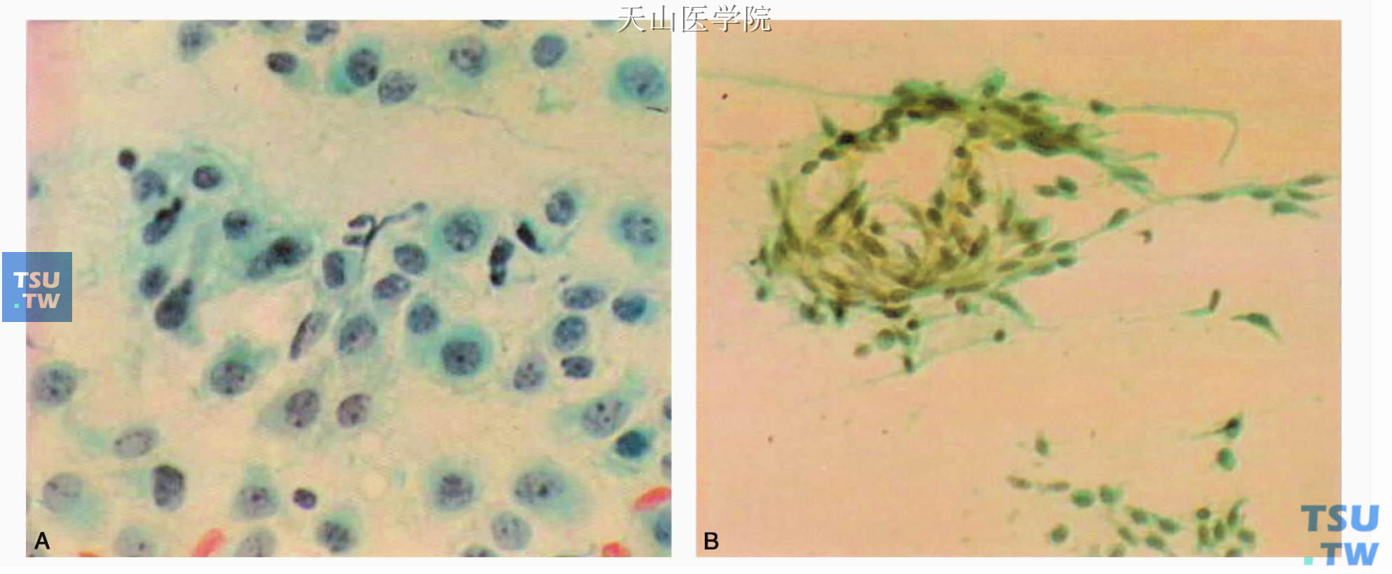 肌上皮瘤：A.浆细胞样瘤细胞；B.梭形细胞样瘤细胞