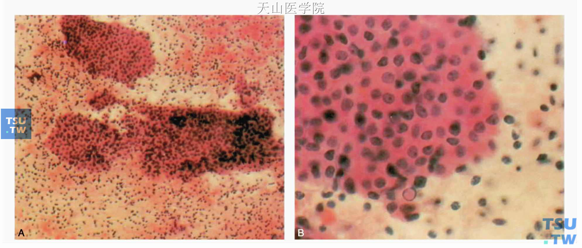 Warthin瘤：A.成片的嗜伊红腺上皮位于背景为淋巴细胞中；B.嗜伊红腺上皮细胞，细胞界限清楚，核居中