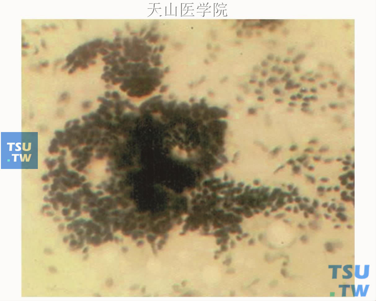 基底细胞腺瘤细胞学表现