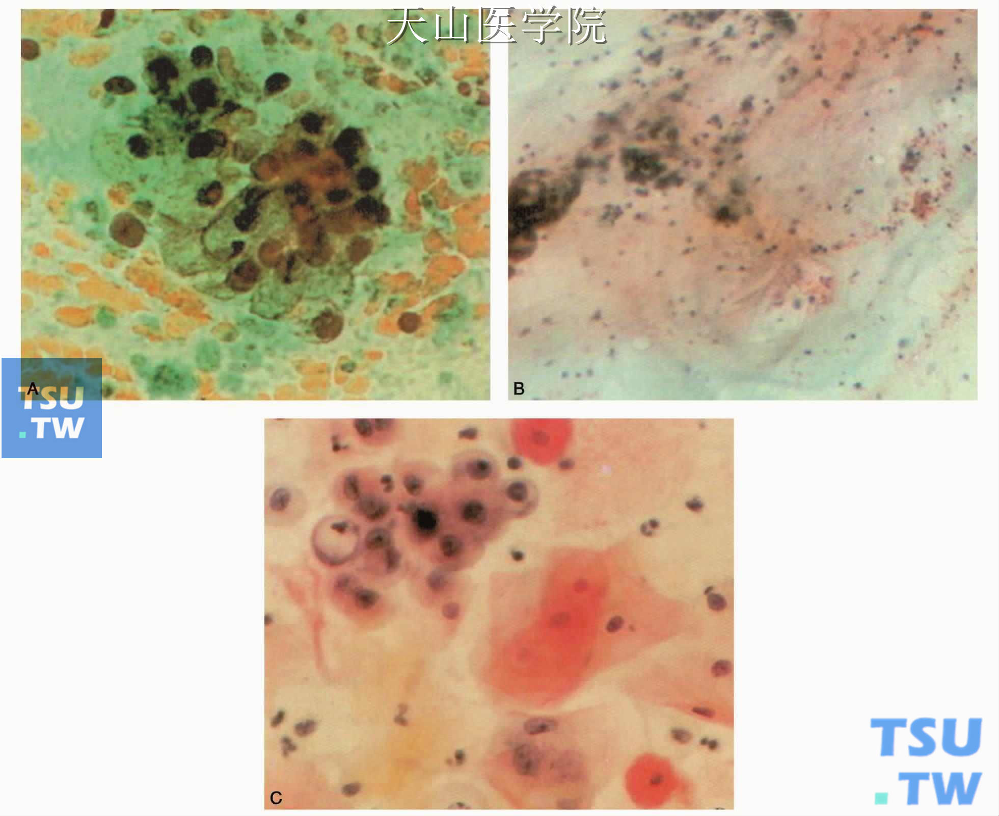黏液表皮样癌：A.黏液细胞和点滴状黏液；B.云雾状黏液；C.表皮样细胞和黏液细胞，后者核周透明区为黏液