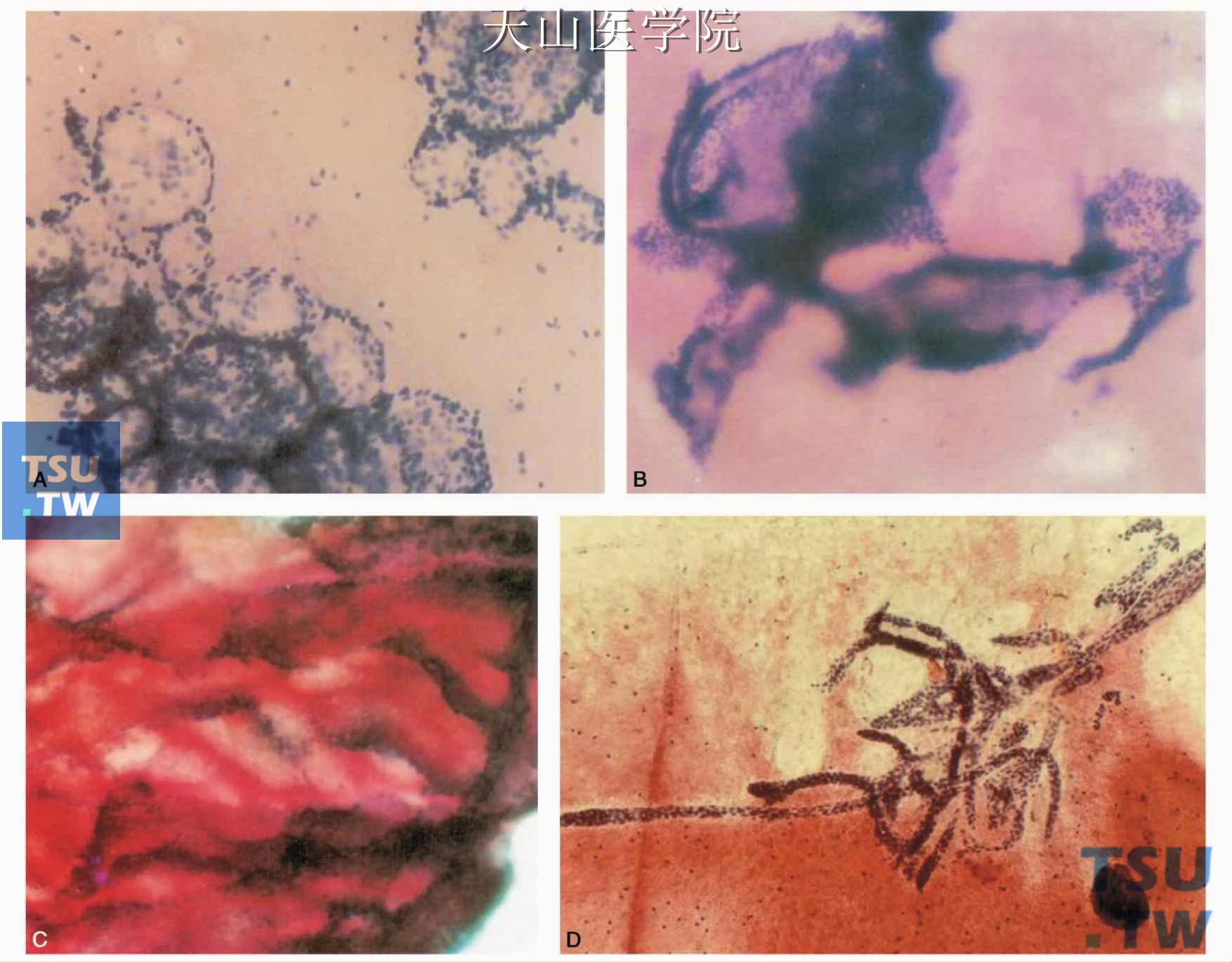 腺样囊性癌细胞学表现