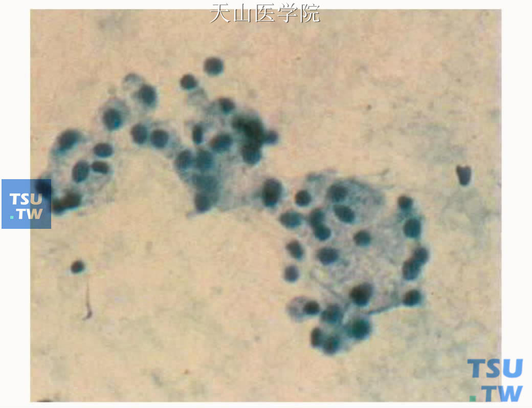 腺泡细胞癌细胞学表现