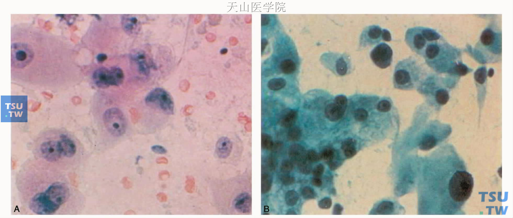 腺癌：A.分化好的腺癌；B.分化差的腺癌