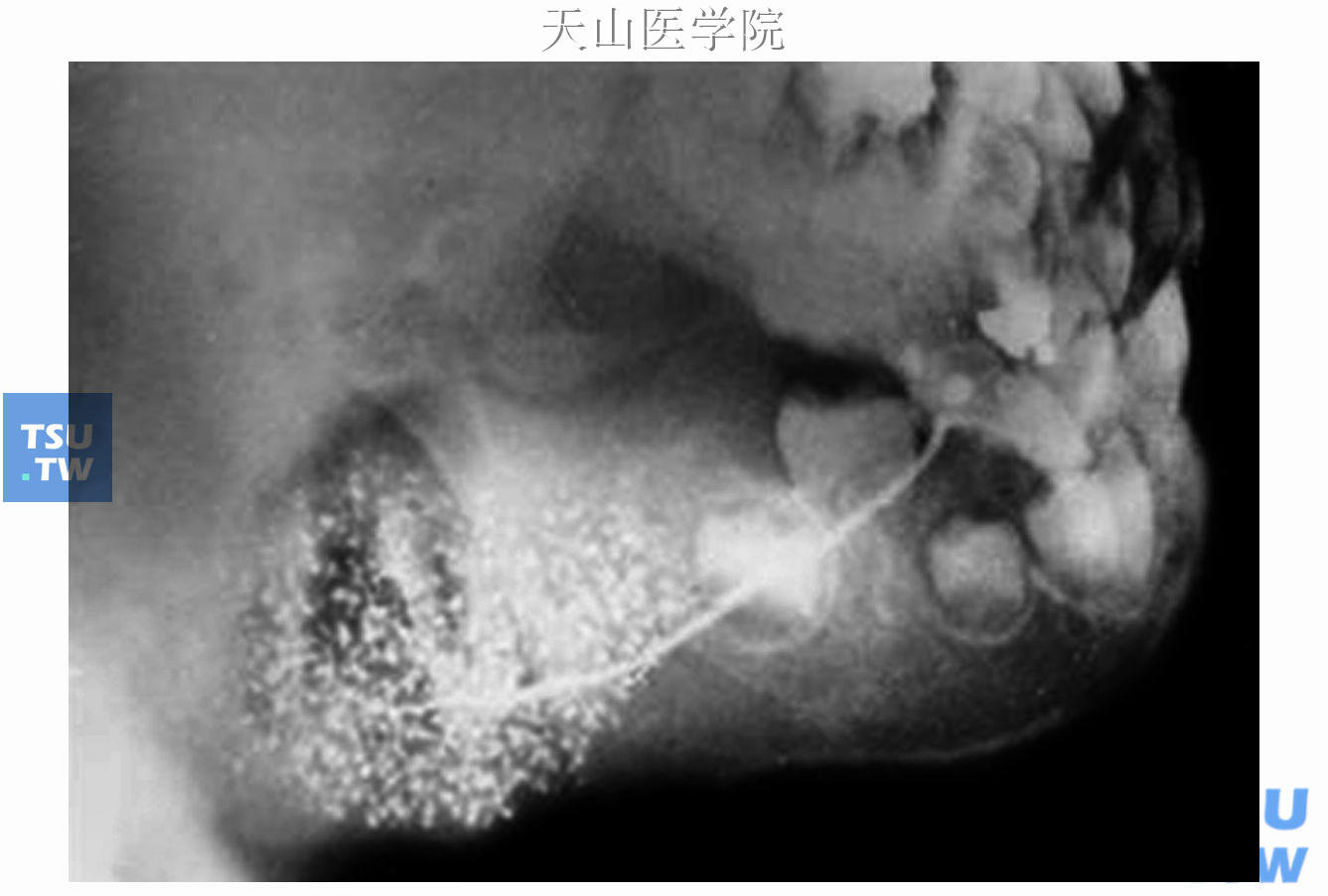 儿童复发性腮腺炎腮腺造影表现