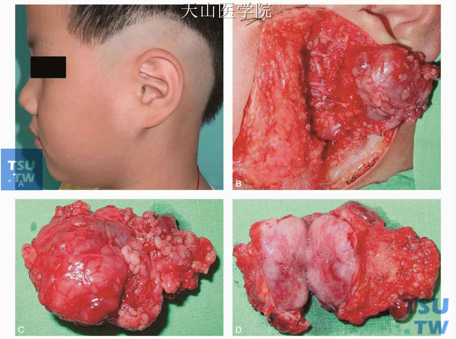 腮腺混合瘤图片良性图片