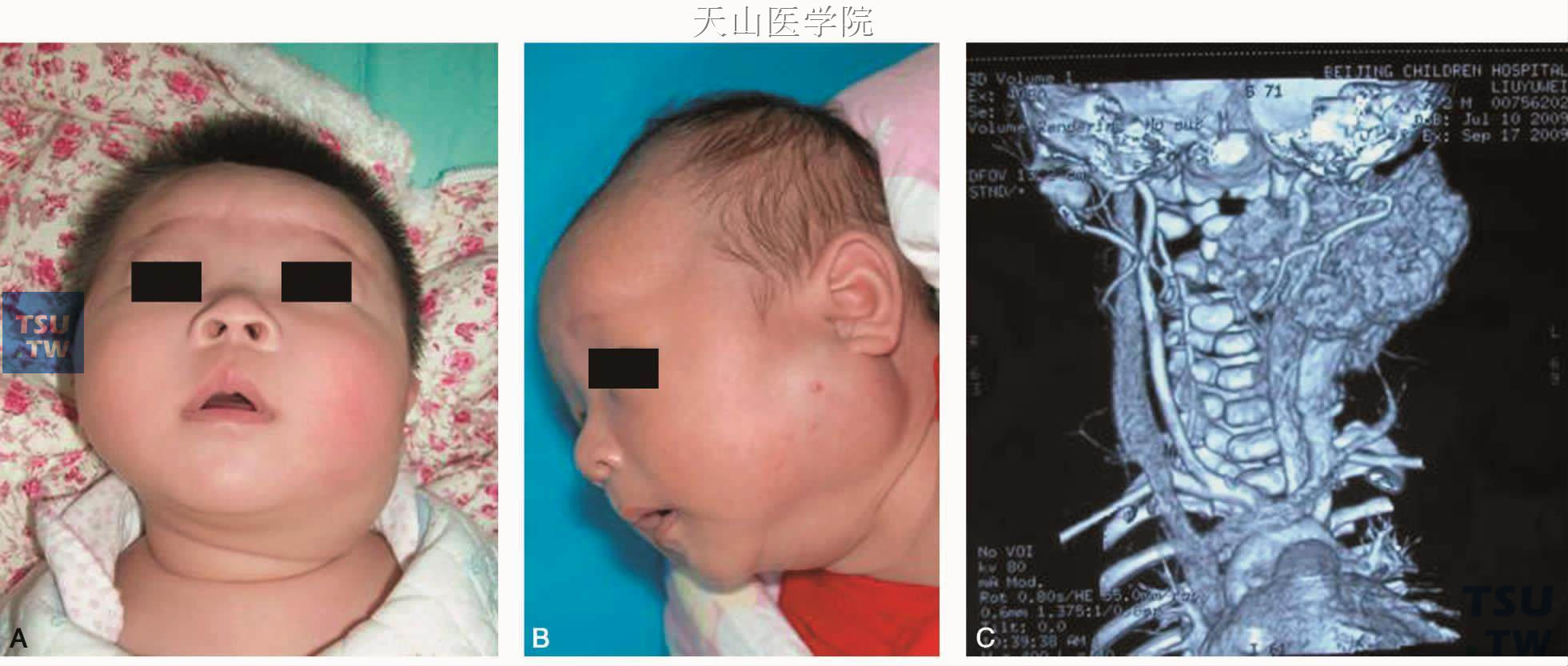 婴幼儿腮腺血管瘤：A.正面像；B.侧面像；C.增强CT显示异常血管团