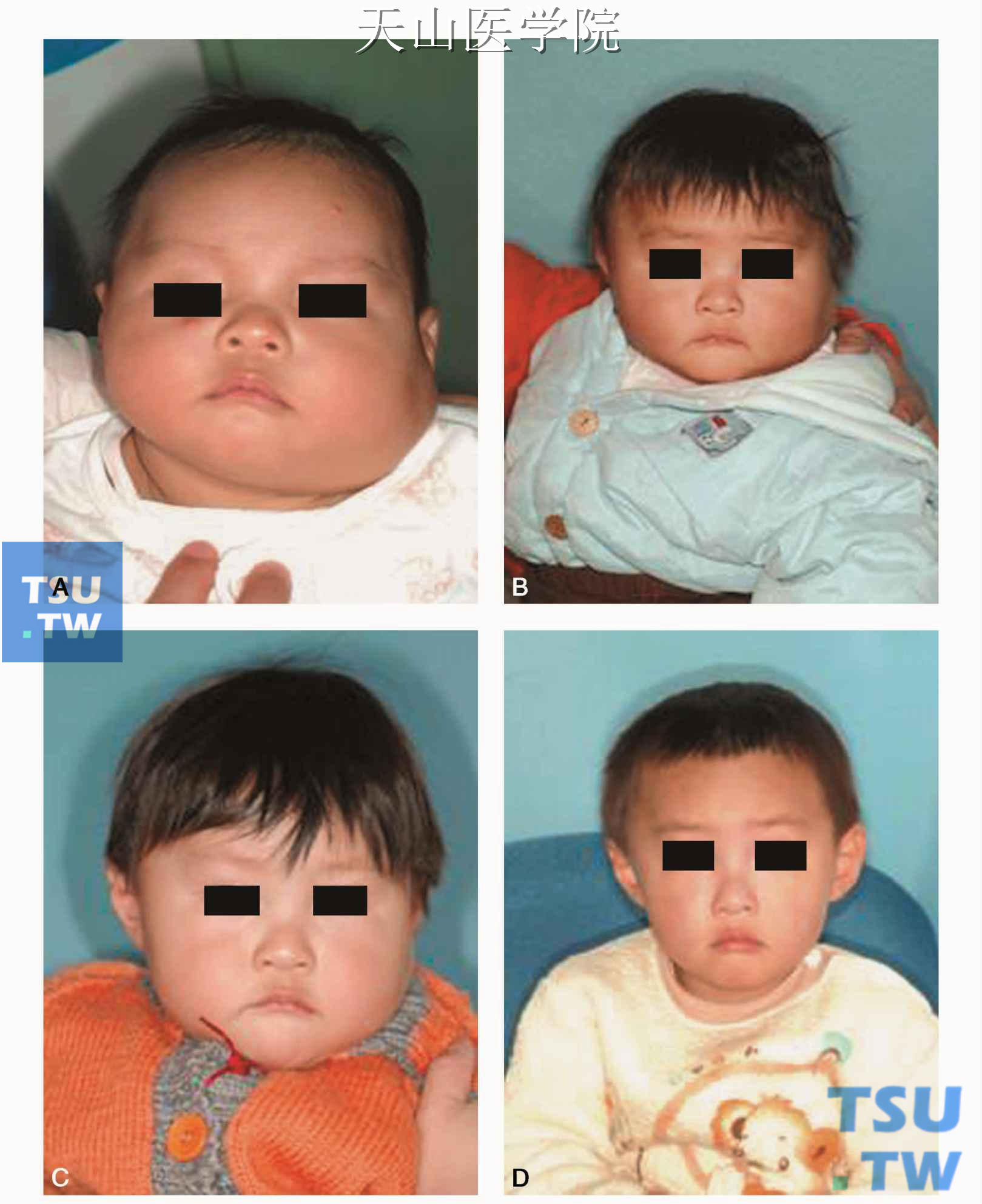 婴幼儿腮腺血管瘤治疗过程：A. 48天初诊时，左腮腺肥大；B.治疗3个月后病变缩小；C.治疗6个月后病变消退；D.治疗2年后血管瘤无复发