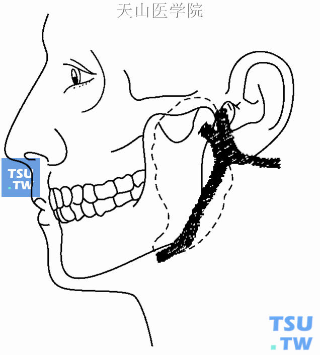 鳃裂瘘可能出现的部位及其和外耳道关系