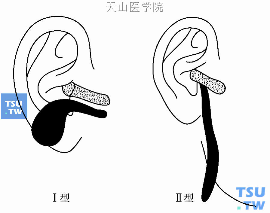 第一鳃裂囊肿和鳃裂瘘的Work分型