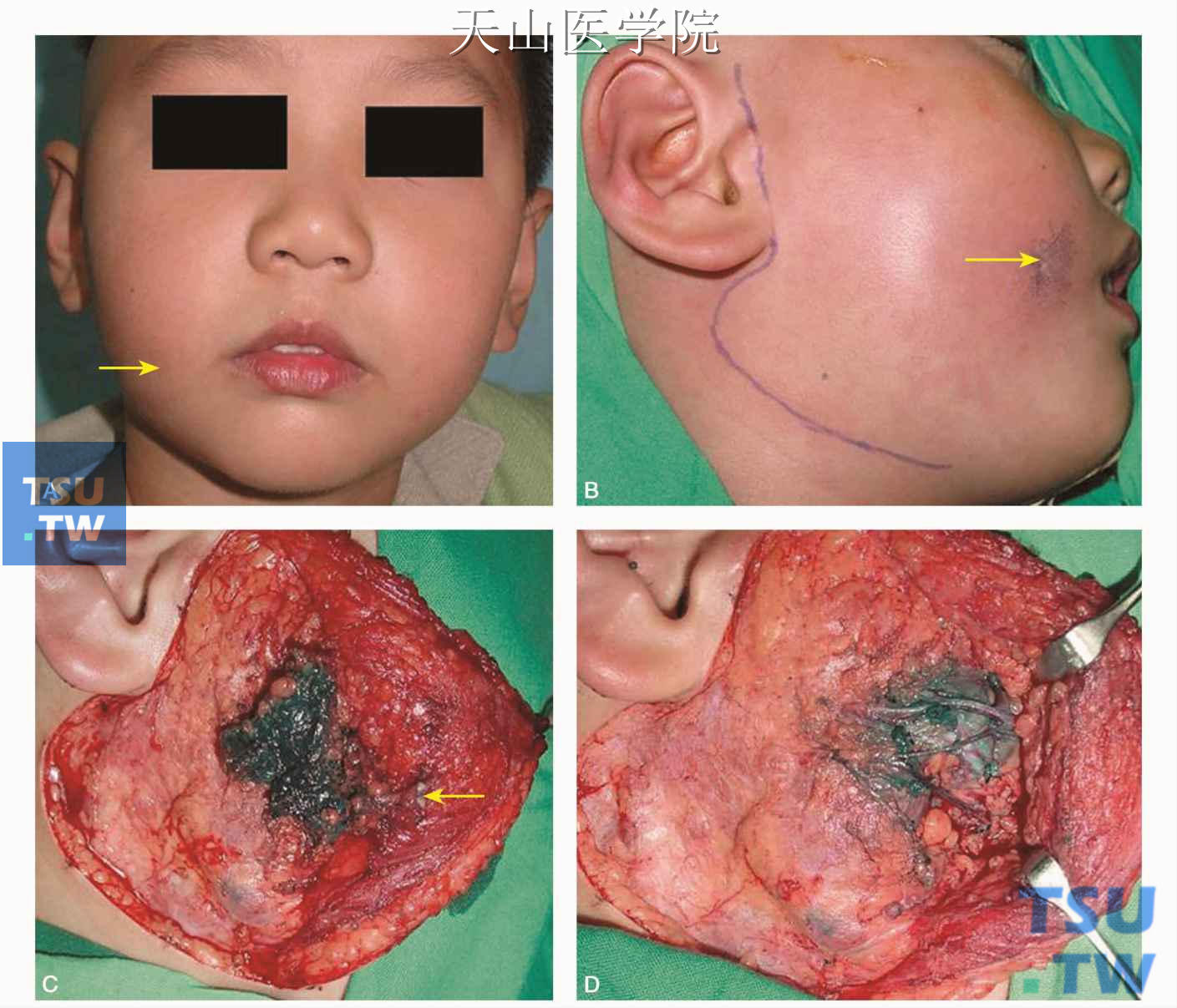 腮腺导管口红点图片