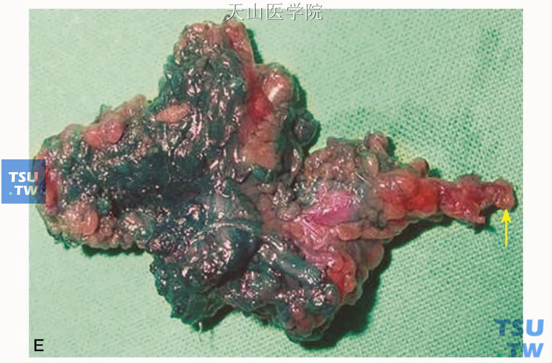 第一鳃裂瘘及腮腺浅叶切除